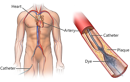 heart groin through test Englewood Cardiac Health Physician  Catheterization