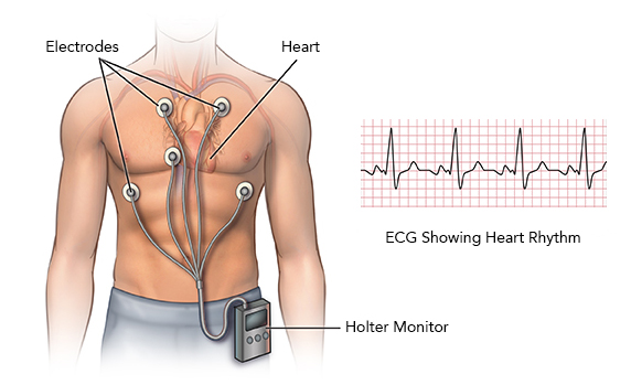 What Is Ambulatory Ecg Monitoring