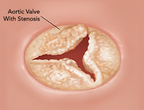 Aorta Heart Valve Problems